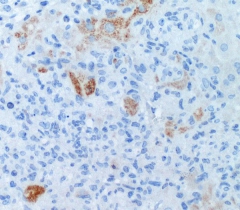Leberzellen unter dem Mikroskop. Apoptotische Zellen sind braun gefärbt, Zellkerne blau. HZI/ Schmitz